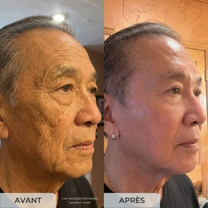 Amelovi® Micro-Infusion Pro™