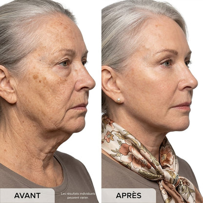 Amelovi® Micro-Infusion Pro™